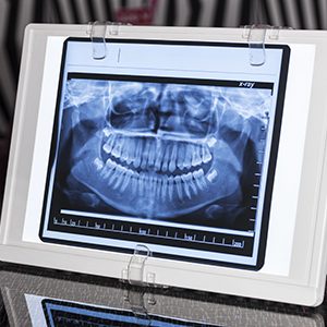 Dental Panoramic x-ray in Viewer with Reflectin