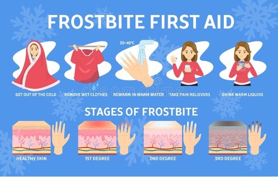 first aid for frostbite