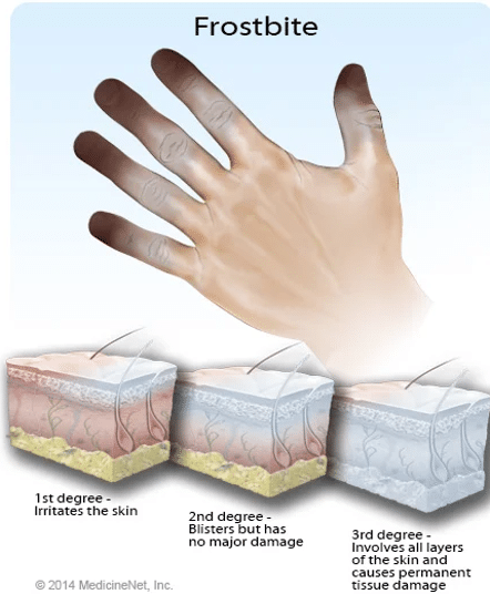 Frostbite chart